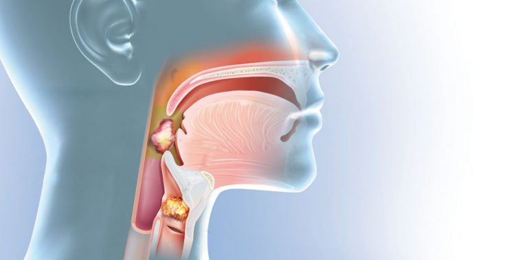 Tại sao tầm soát ung thư vòm họng là cách ngăn ngừa bệnh ung thư tốt nhất hiện nay
